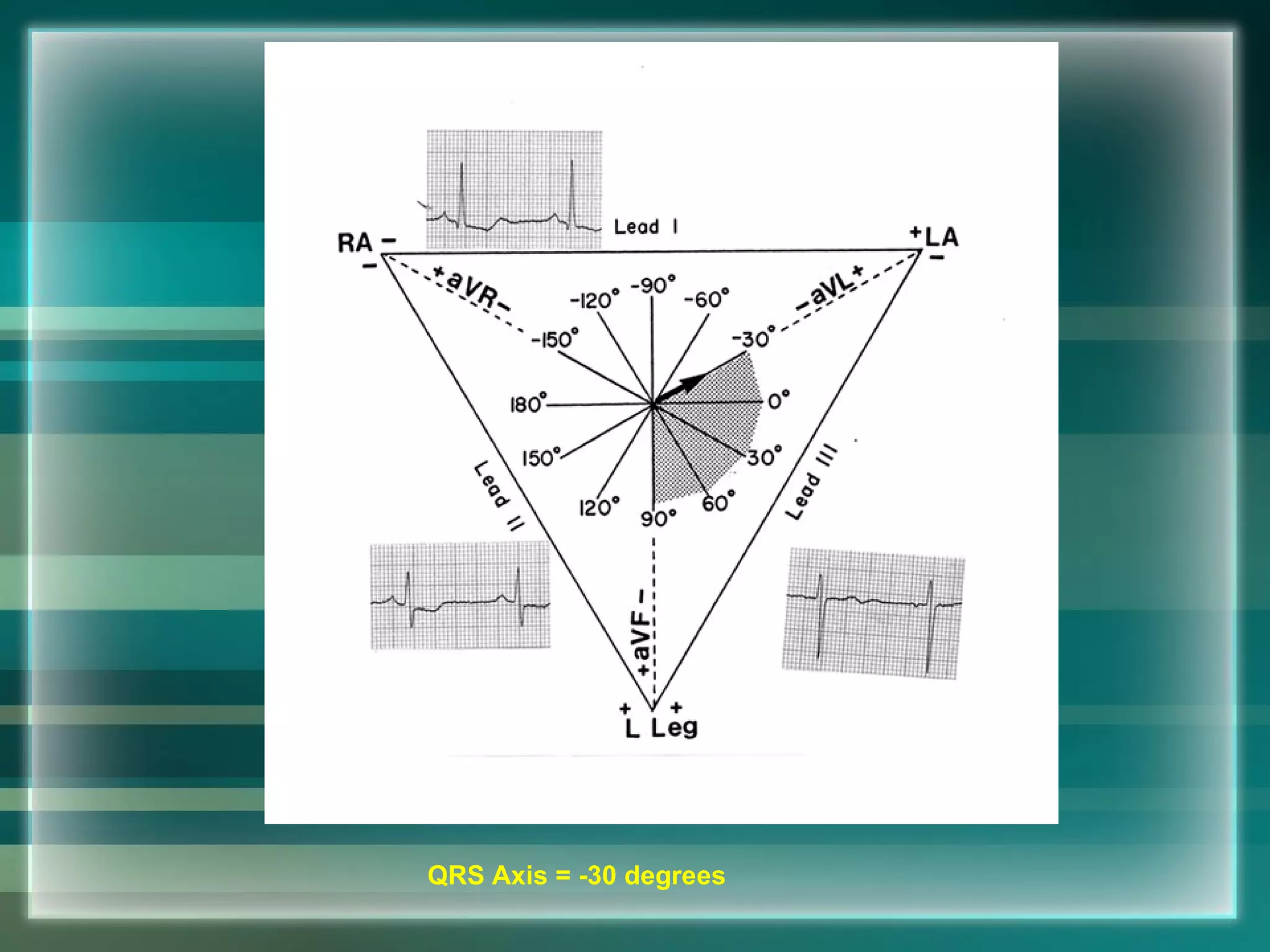 QRS Axis = -30 degrees 