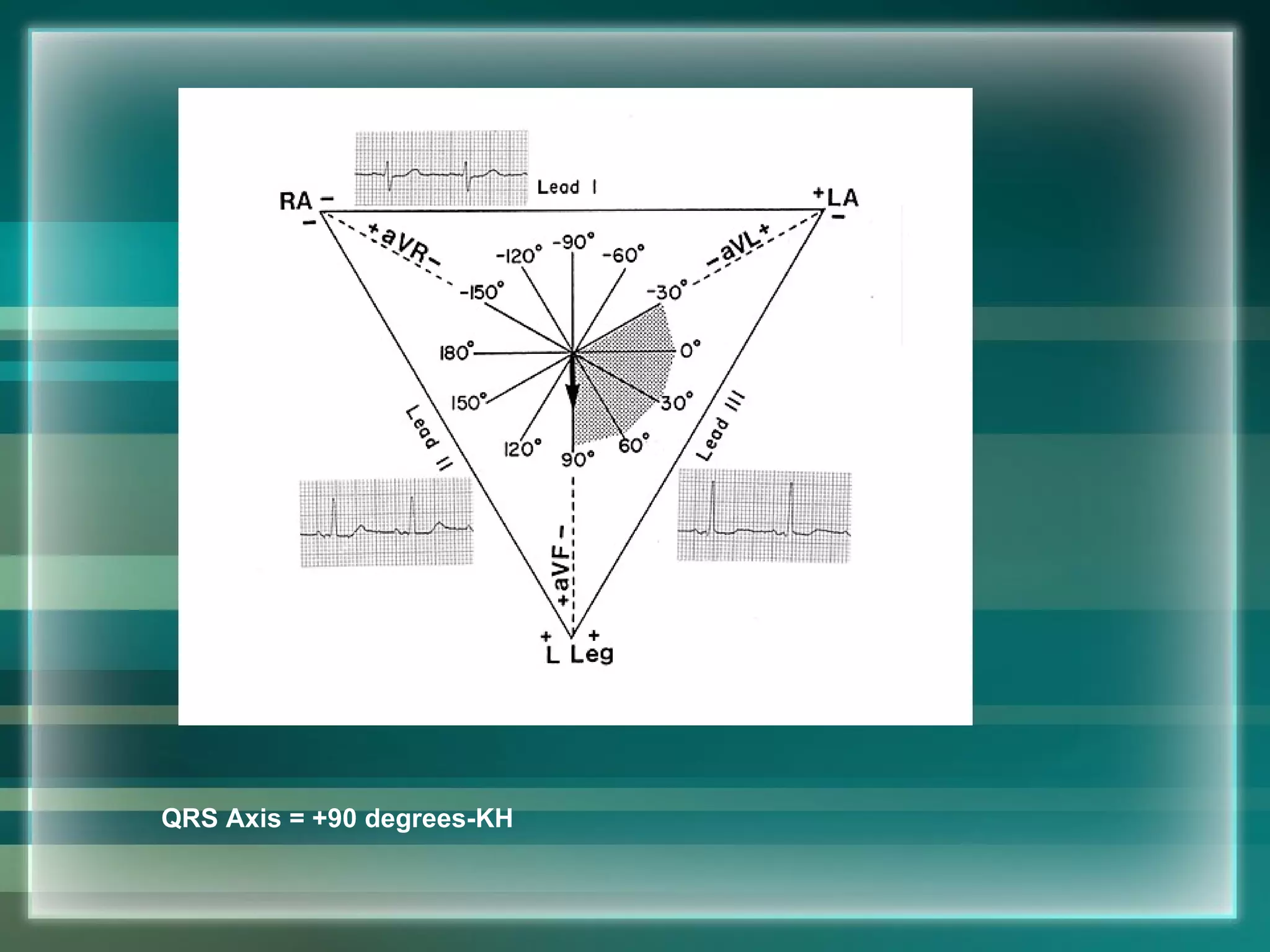                                                                      QRS Axis = +90 degrees-KH 