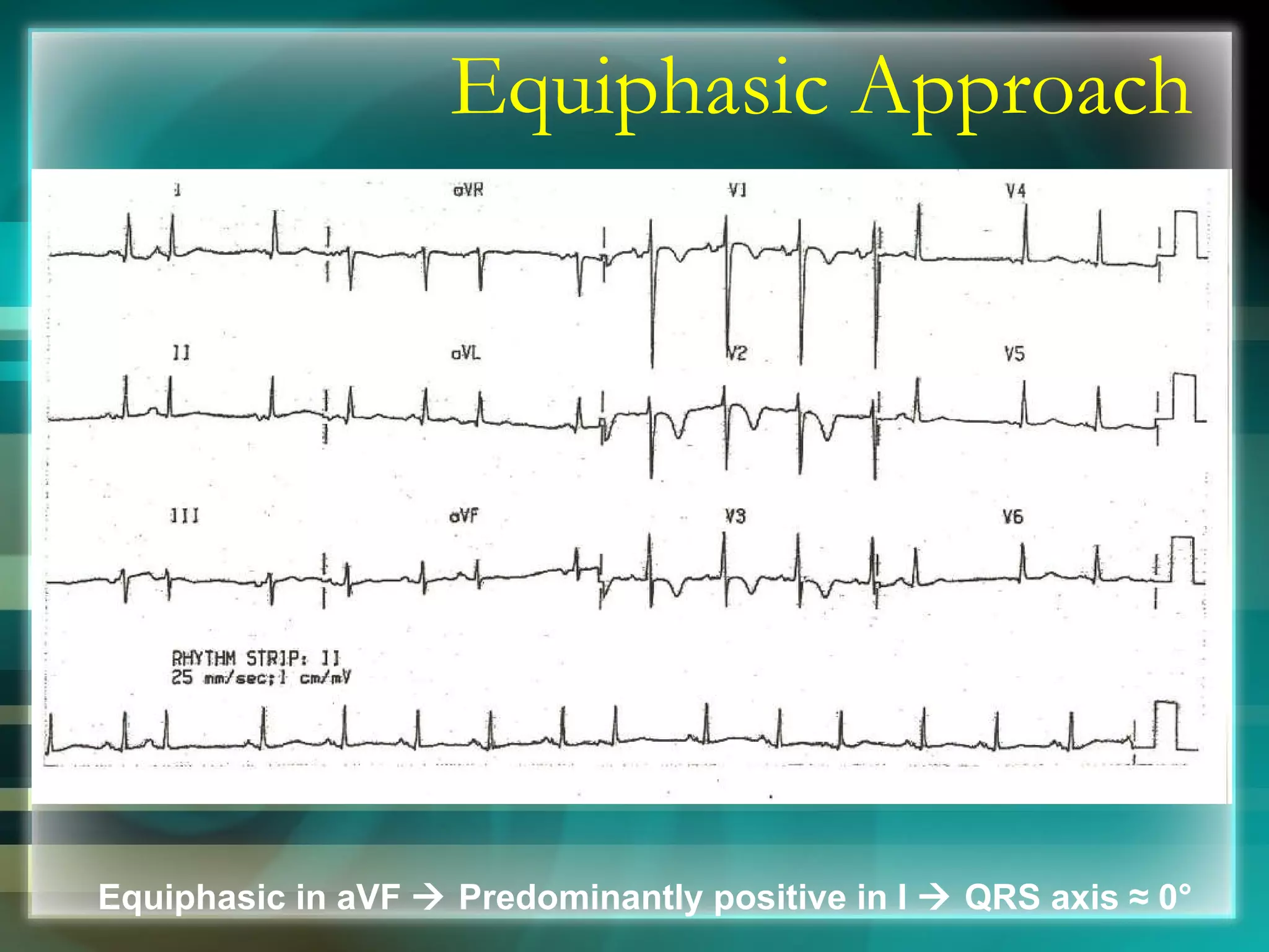 Equiphasic Approach Equiphasic in aVF    Predominantly positive in I    QRS axis  ≈ 0° 