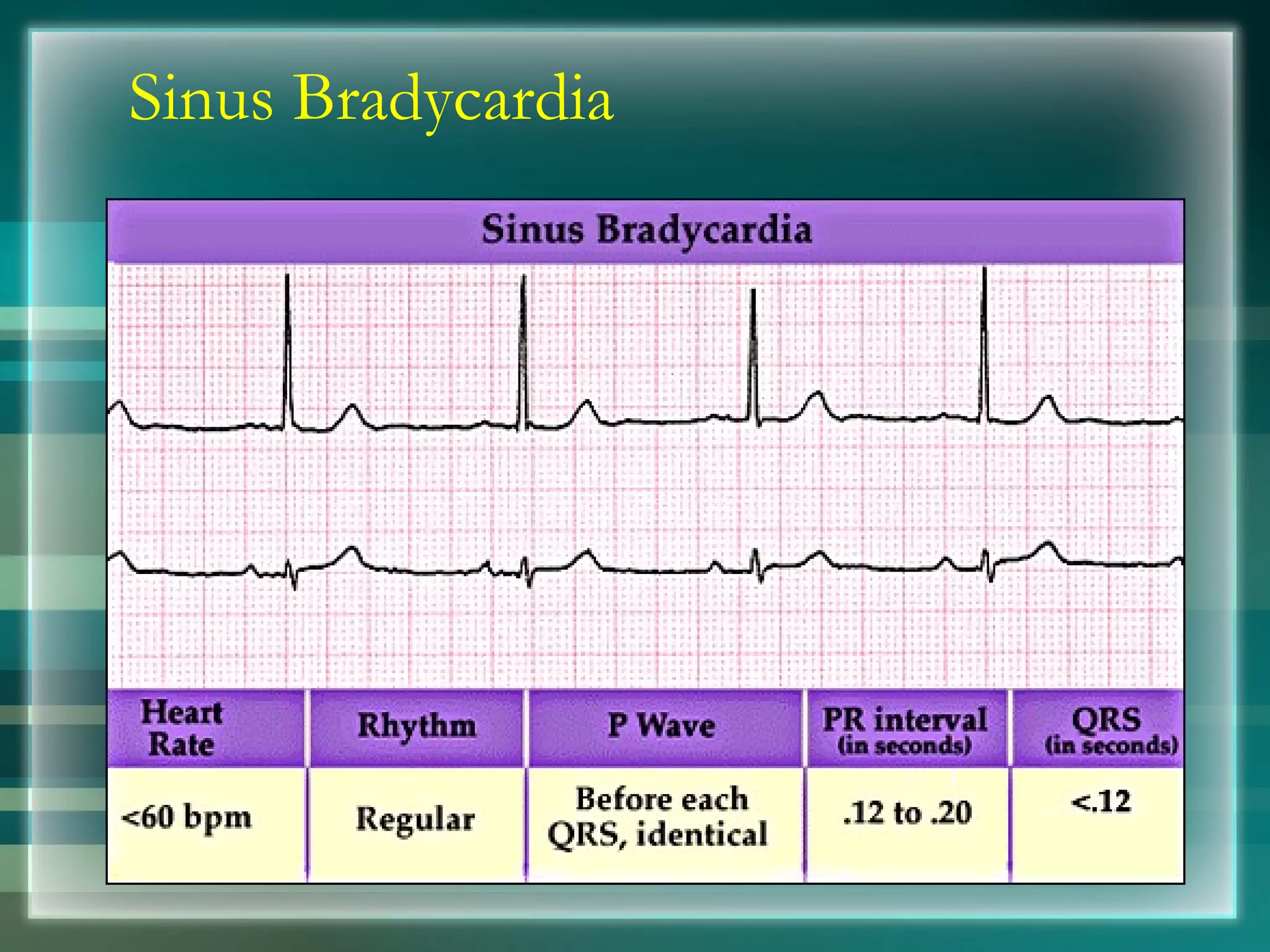 Sinus Bradycardia 