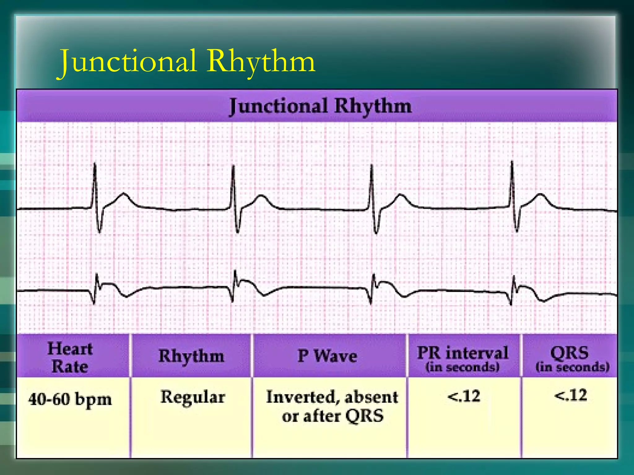 Junctional Rhythm 
