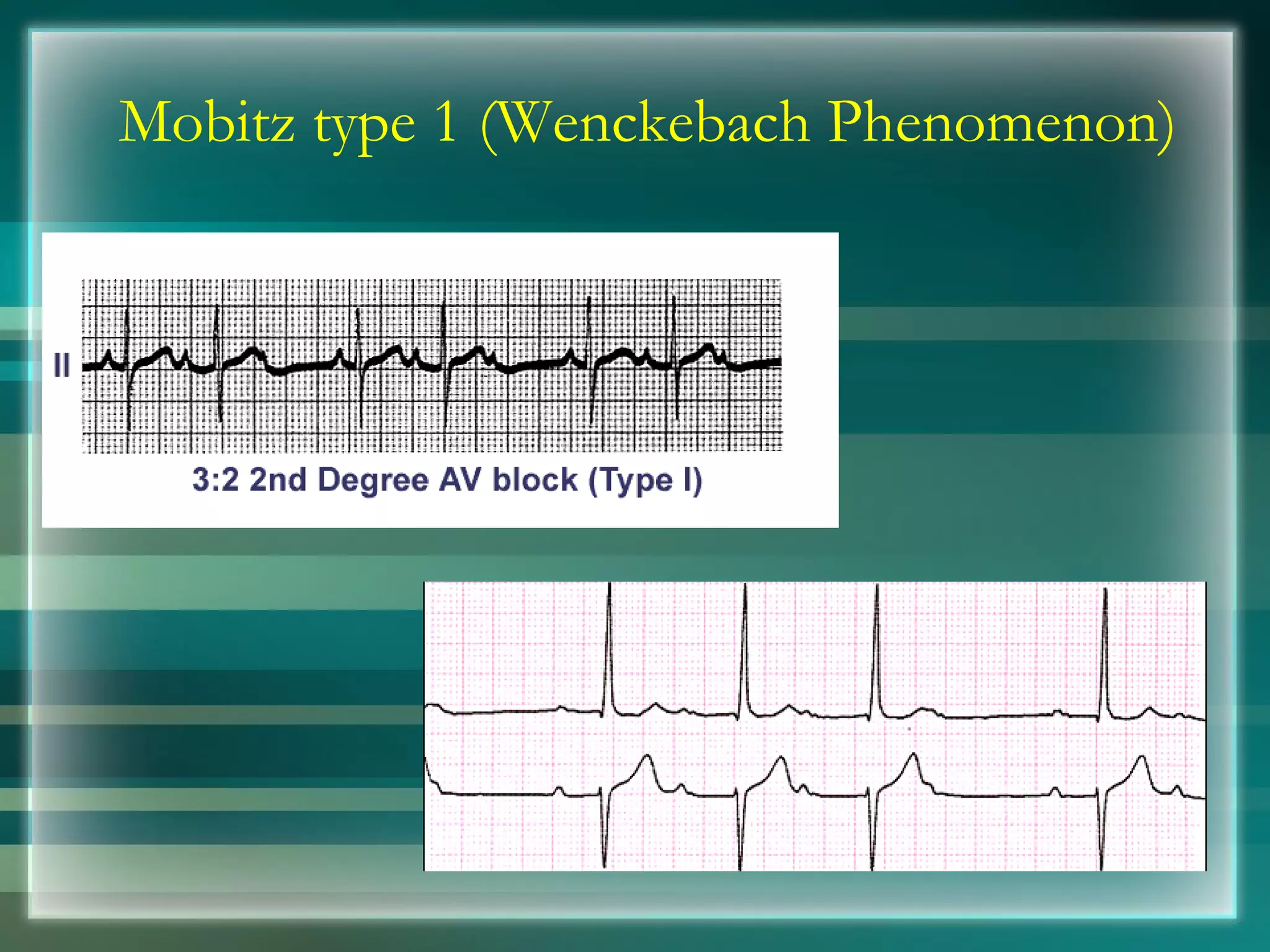 Mobitz type 1 (Wenckebach Phenomenon) 