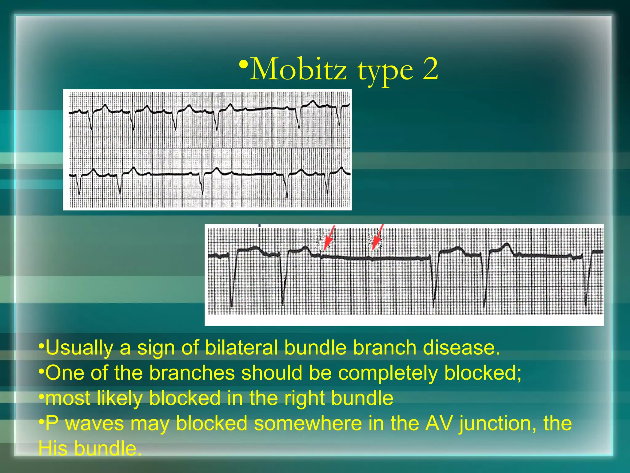 Mobitz type 2 Usually a sign of bilateral bundle branch disease. One of the branches should be completely blocked; most likely blocked in the right bundle  P waves may blocked somewhere in the AV junction, the His bundle. 