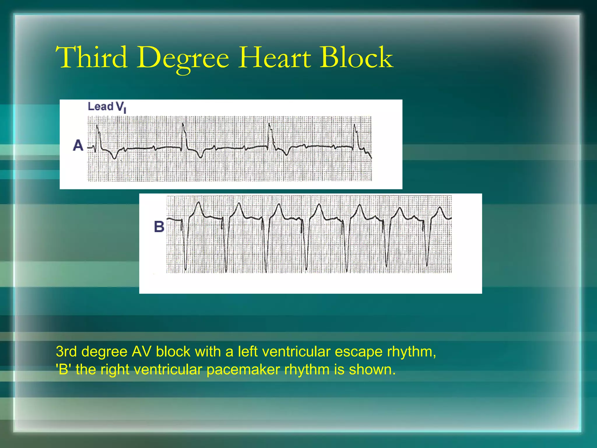 Third Degree Heart Block 3rd degree AV block with a left ventricular escape rhythm,  'B' the right ventricular pacemaker rhythm is shown. 