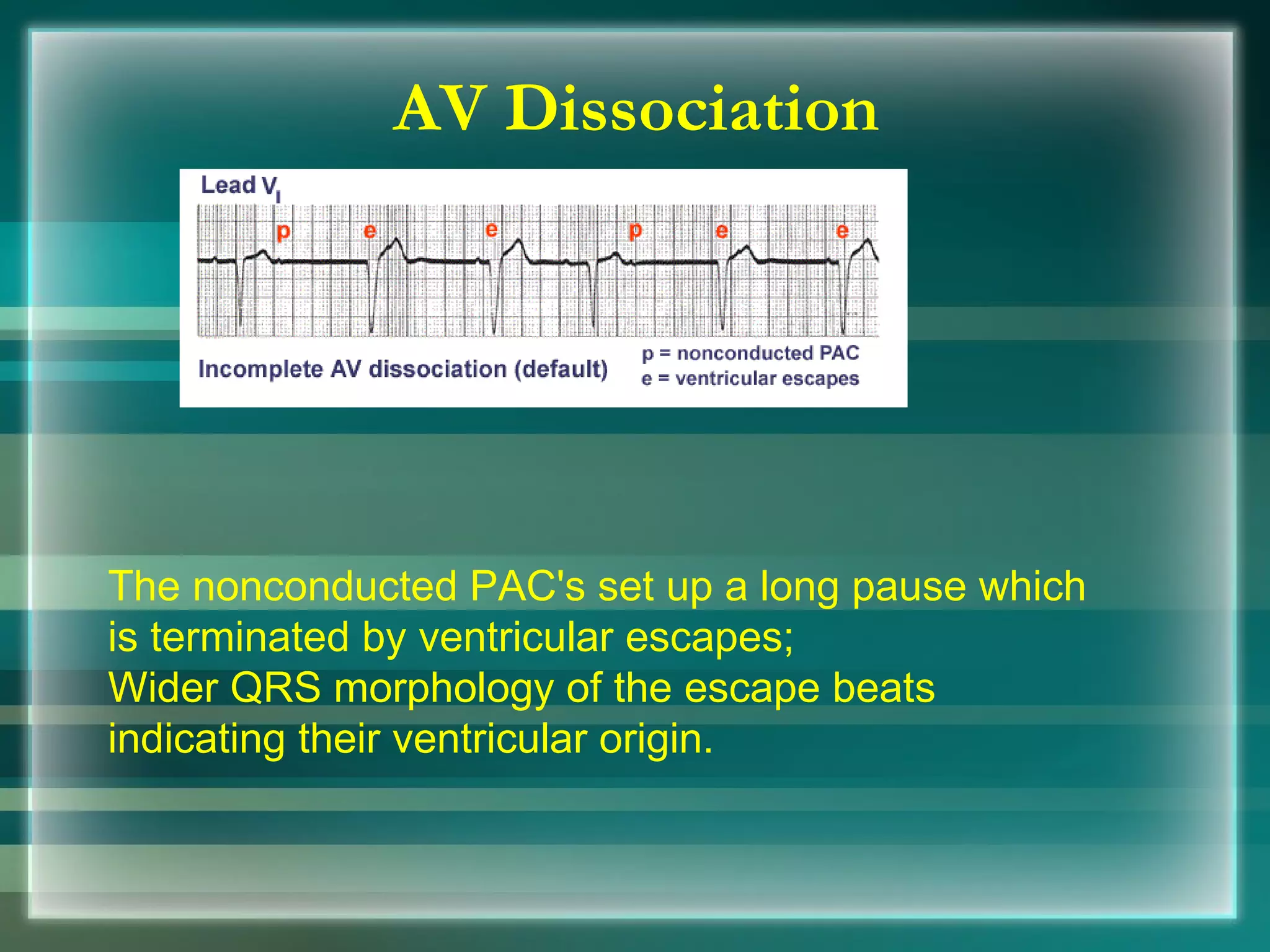 The nonconducted PAC's set up a long pause which is terminated by ventricular escapes;  Wider QRS morphology of the escape beats indicating their ventricular origin.  AV Dissociation 