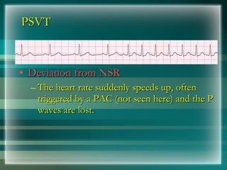 PSVT <ul><li>Deviation from NSR </li></ul><ul><ul><li>The heart rate suddenly speeds up, often triggered by a PAC (not see...