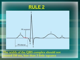   RULE 2 <ul><li>The width of the QRS complex should not exceed 110 ms, less than 3 little squares </li></ul>