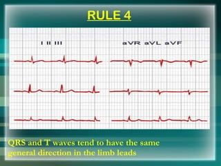 RULE 4 <ul><li>QRS and T waves tend to have the same general direction in the limb leads </li></ul>