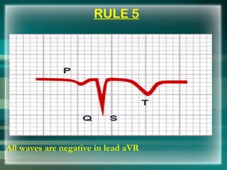 RULE 5 <ul><li>All waves are negative in lead aVR </li></ul>