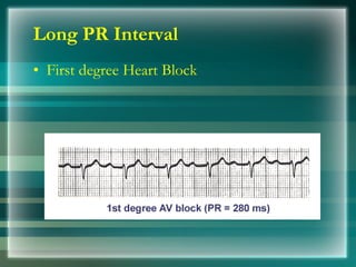 Long PR Interval <ul><li>First degree Heart Block </li></ul>