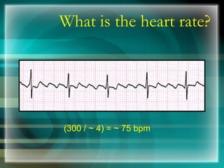 What is the heart rate? (300 / ~ 4) = ~ 75 bpm 