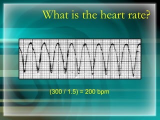What is the heart rate? (300 / 1.5) = 200 bpm 
