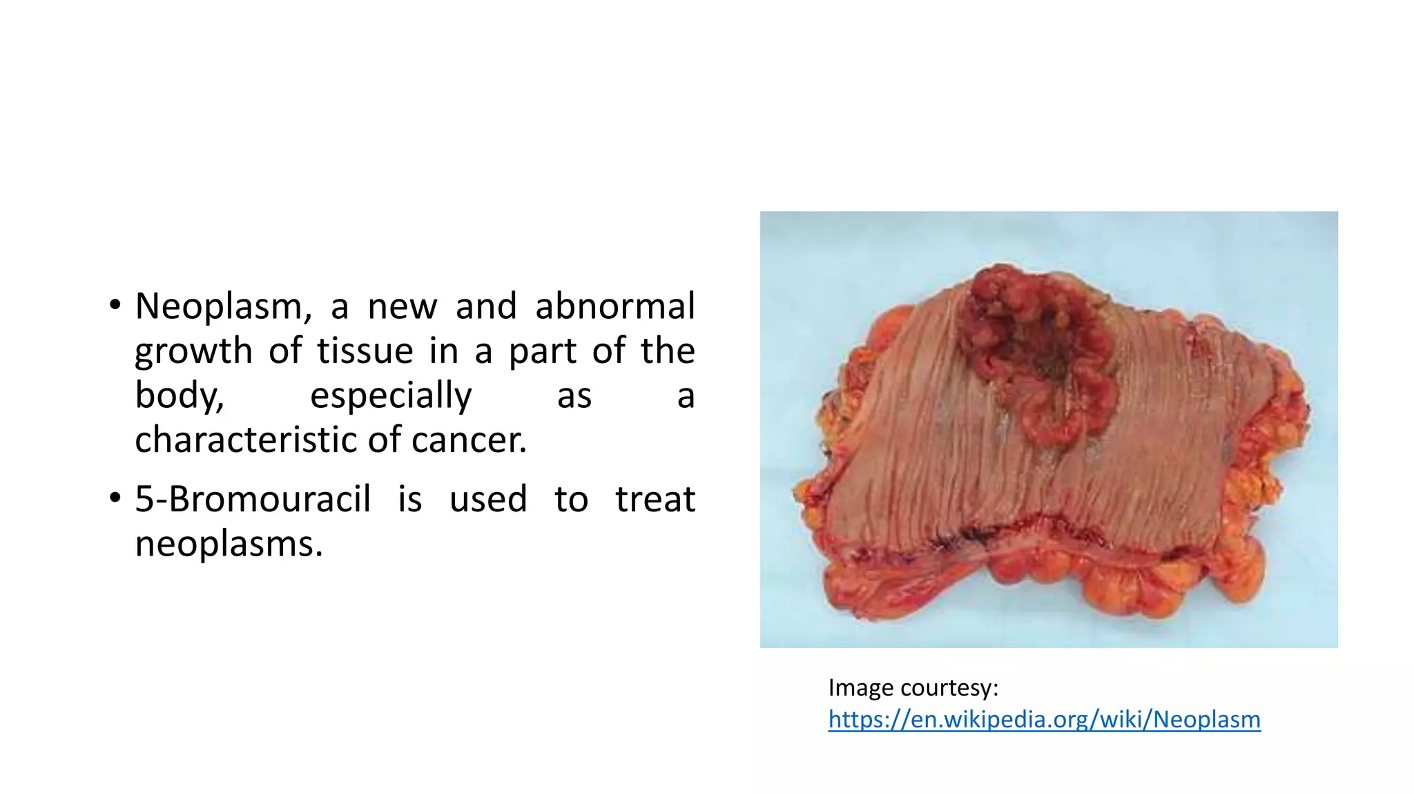 • Neoplasm, a new and abnormal
growth of tissue in a part of the
body, especially as a
characteristic of cancer.
• 5-Bromouracil is used to treat
neoplasms.
Image courtesy:
https://en.wikipedia.org/wiki/Neoplasm
 
