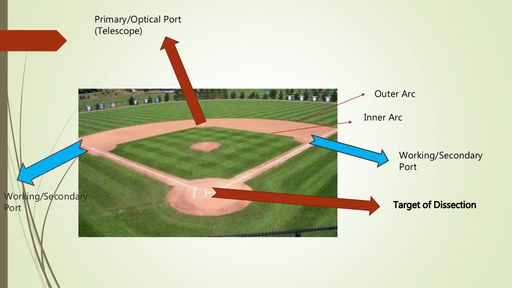 Baseball diamond concept for port position in laparoscopy