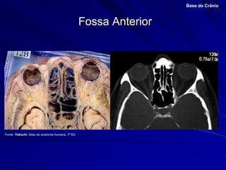 Fossa Anterior
Base do Crânio
Fonte: Yokochi, Atlas de anatomia humana, 7ª Ed.
 