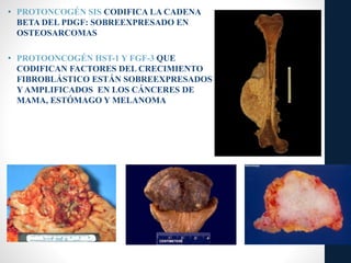 • PROTONCOGÉN SIS CODIFICA LA CADENA
BETA DEL PDGF: SOBREEXPRESADO EN
OSTEOSARCOMAS
• PROTOONCOGÉN HST-1 Y FGF-3 QUE
CODIFICAN FACTORES DEL CRECIMIENTO
FIBROBLÁSTICO ESTÁN SOBREEXPRESADOS
Y AMPLIFICADOS EN LOS CÁNCERES DE
MAMA, ESTÓMAGO Y MELANOMA
 