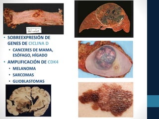 • SOBREEXPRESIÓN DE
GENES DE CICLINA D
• CANCERES DE MAMA,
ESÓFAGO, HÍGADO
• AMPLIFICACIÓN DE CDK4
• MELANOMA
• SARCOMAS
• GLIOBLASTOMAS
 