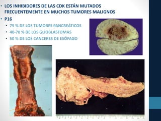 • LOS INHIBIDORES DE LAS CDK ESTÁN MUTADOS
FRECUENTEMENTE EN MUCHOS TUMORES MALIGNOS
• P16
• 75 % DE LOS TUMORES PANCREÁTICOS
• 40-70 % DE LOS GLIOBLASTOMAS
• 50 % DE LOS CANCERES DE ESÓFAGO
 