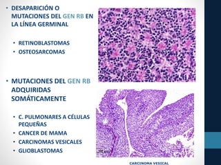 • DESAPARICIÓN O
MUTACIONES DEL GEN RB EN
LA LÍNEA GERMINAL
• RETINOBLASTOMAS
• OSTEOSARCOMAS
• MUTACIONES DEL GEN RB
ADQUIRIDAS
SOMÁTICAMENTE
• C. PULMONARES A CÉLULAS
PEQUEÑAS
• CANCER DE MAMA
• CARCINOMAS VESICALES
• GLIOBLASTOMAS
CARCINOMA VESICAL
 