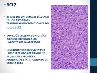 •BCL2
• 85 % DE LOS LINFOMAS DE CÉLULAS B
FOLICULARES TIENEN
TRANSLOCACIÓN CROMOSÓMICA DEL
LOCUS Bcl2
• EXPRESIÓN EXCESIVA DE PROTEÍNA
Bcl 2 QUE PROTEGEN A LOS
LINFOCITOS DE LA APOPTOSIS
• LOS LINFOCITOS SOBREVIVEN POR
LARGOS PERÍODOS DE TIEMPO, SE
ACUMULAN Y PRODUCEN
ADENOPATÍAS E INFILTRACIÓN DE LA
MÉDULA ÓSEA
 