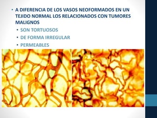 • A DIFERENCIA DE LOS VASOS NEOFORMADOS EN UN
TEJIDO NORMAL LOS RELACIONADOS CON TUMORES
MALIGNOS
• SON TORTUOSOS
• DE FORMA IRREGULAR
• PERMEABLES
 