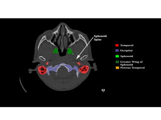 “BASE OF SKULL: ANATOMY and APPLIED ASPECT” | PDF