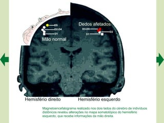Magnetoencefalograma realizado nos dois lados do cérebro de indivíduos
distônicos revelou alterações no mapa somatotópico do hemisfério
esquerdo, que recebe informações da mão direita.
 
