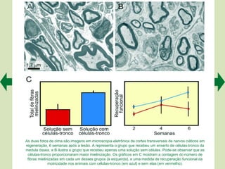 As duas fotos de cima são imagens em microscopia eletrônica de cortes transversais de nervos ciáticos em
regeneração, 6 semanas após a lesão. A representa o grupo que recebeu um enxerto de células-tronco da
medula óssea, e B ilustra o grupo que recebeu apenas uma solução sem células. Pode-se observar que as
 células-tronco proporcionaram maior mielinização. Os gráficos em C mostram a contagem do número de
 fibras mielinizadas em cada um desses grupos (à esquerda), e uma medida de recuperação funcional da
              motricidade nos animais com células-tronco (em azul) e sem elas (em vermelho).
 