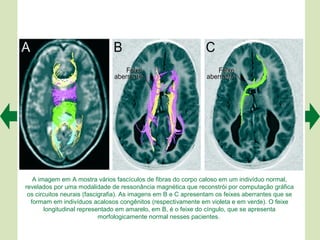 A imagem em A mostra vários fascículos de fibras do corpo caloso em um indivíduo normal,
revelados por uma modalidade de ressonância magnética que reconstrói por computação gráfica
 os circuitos neurais (fascigrafia). As imagens em B e C apresentam os feixes aberrantes que se
  formam em indivíduos acalosos congênitos (respectivamente em violeta e em verde). O feixe
       longitudinal representado em amarelo, em B, é o feixe do cíngulo, que se apresenta
                            morfologicamente normal nesses pacientes.
 