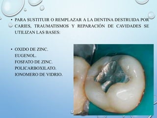 • PARA SUSTITUIR O REMPLAZAR A LA DENTINA DESTRUIDA POR
CARIES, TRAUMATISMOS Y REPARACIÓN DE CAVIDADES SE
UTILIZAN LAS BASES:
• OXIDO DE ZINC.
EUGENOL.
FOSFATO DE ZINC.
POLICARBOXILATO.
IONOMERO DE VIDRIO.
 