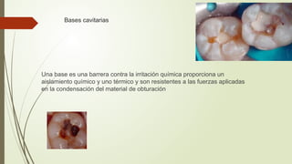Bases cavitarias en la rama de la odontologia | PPTX
