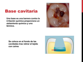 bases cavitarias 2.pptx dentarias clas 1 | PPTX | Oral care | Personal Care