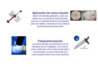 Aplicación de resina líquida Sobre el esmalte grabado y seco se aplica con un pincel la resina líquida, que es un material similar al composite, pero sin relleno. Penetra en los cráteres profundizados previamente Fotopolimerización La resina líquida se polimeriza con la lámpara de luz halógena. Va a servir como medio de unión entre el esmalte y el composite, ya que entre este y la resina puede existir una unión química 