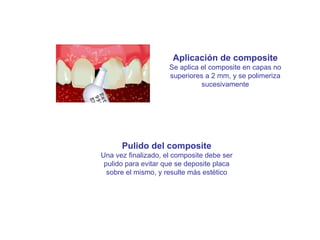 Aplicación de composite Se aplica el composite en capas no superiores a 2 mm, y se polimeriza sucesivamente Pulido del composite Una vez finalizado, el composite debe ser pulido para evitar que se deposite placa sobre el mismo, y resulte más estético 