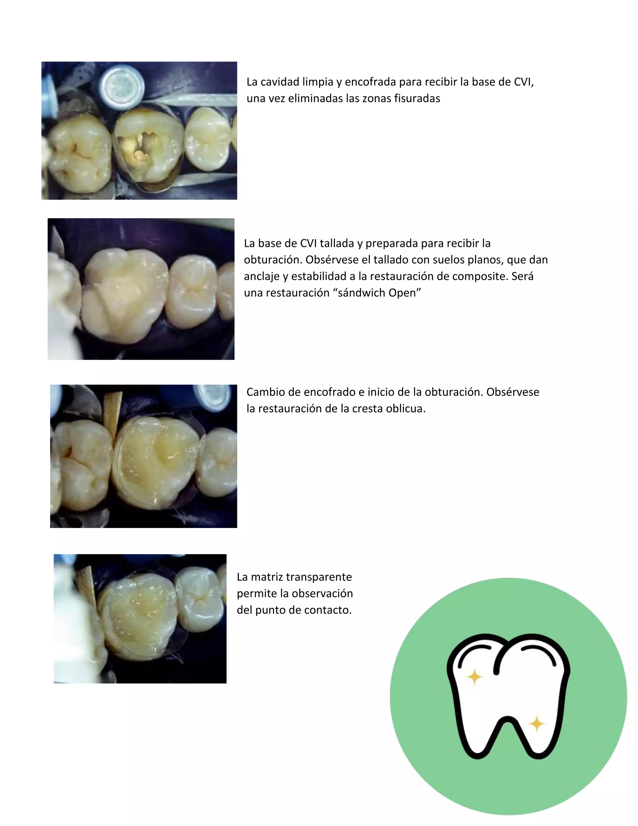 Bases cavitarias y cementos PDF