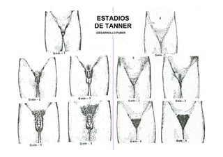 ESTADIOS
DE TANNER
(DESARROLLO PUBERAL)
 