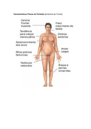 Características Físicas do Portador (síndrome de Turner)
 