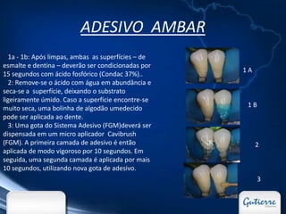 ADESIVO AMBAR
  1a - 1b: Após limpas, ambas as superfícies – de
esmalte e dentina – deverão ser condicionadas por
                                                    1A
15 segundos com ácido fosfórico (Condac 37%)..
  2: Remove-se o ácido com água em abundância e
seca-se a superfície, deixando o substrato
ligeiramente úmido. Caso a superfície encontre-se
muito seca, uma bolinha de algodão umedecido         1B
pode ser aplicada ao dente.
  3: Uma gota do Sistema Adesivo (FGM)deverá ser
dispensada em um micro aplicador Cavibrush
(FGM). A primeira camada de adesivo é então              2
aplicada de modo vigoroso por 10 segundos. Em
seguida, uma segunda camada é aplicada por mais
10 segundos, utilizando nova gota de adesivo.
                                                          3
 