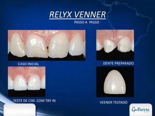 RELYX VENNER
                           PASSO A PASSO




  CASO INICIAL                              DENTE PREPARADO




TESTE DE CIM. COM TRY IN                   VEENER TESTADO
 