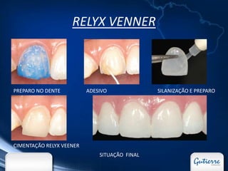 RELYX VENNER



PREPARO NO DENTE          ADESIVO              SILANIZAÇÃO E PREPARO




CIMENTAÇÃO RELYX VEENER
                              SITUAÇÃO FINAL
 