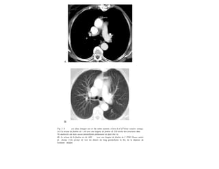 A
B
Fig. I. S ces deux irnoges aie or the some section, v/ewe d of d/7eren/ window settings.
(A) Un niveau de fenêtre oL+ zt0 avec une largeur de fenêtre oL 350 révèle des structures dans
/#e mediostin um mais aucun porencñymo pulmonaire ne peut être vu.
(B) Le niveau de la fenêtre est de -b00 avec une largeur de fenêtre de L ITOO Houns unités
de champ. Cela permet de voir les détails du long porencñymo la ibe, de la dépense de
l'ostinum médian.
 