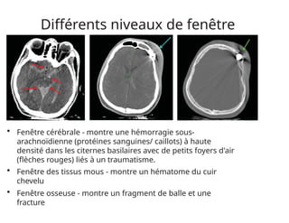 Différents niveaux de fenêtre
• Fenêtre cérébrale - montre une hémorragie sous-
arachnoïdienne (protéines sanguines/ caillots) à haute
densité dans les citernes basilaires avec de petits foyers d'air
(flèches rouges) liés à un traumatisme.
• Fenêtre des tissus mous - montre un hématome du cuir
chevelu
• Fenêtre osseuse - montre un fragment de balle et une
fracture
 