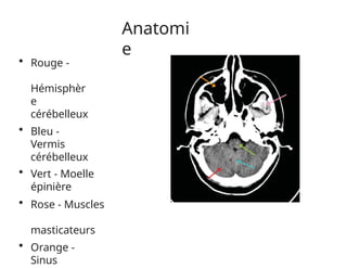 Anatomi
e
• Rouge -
Hémisphèr
e
cérébelleux
• Bleu -
Vermis
cérébelleux
• Vert - Moelle
épinière
• Rose - Muscles
masticateurs
• Orange -
Sinus
 