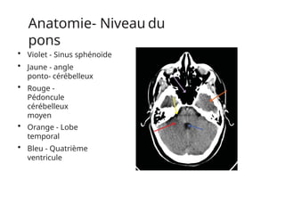 Anatomie- Niveau du
pons
• Violet - Sinus sphénoïde
• Jaune - angle
ponto- cérébelleux
• Rouge -
Pédoncule
cérébelleux
moyen
• Orange - Lobe
temporal
• Bleu - Quatrième
ventricule
 