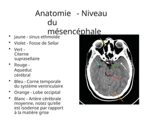 Anatomie - Niveau
du
mésencéphale
• Jaune - sinus ethmoïde
• Violet - Fosse de Sellar
• Vert -
Citerne
suprasellaire
• Rouge -
Aqueduc
cérébral
• Bleu - Corne temporale
du système ventriculaire
• Orange - Lobe occipital
• Blanc - Artère cérébrale
moyenne, notez qu'elle
est isodense par rapport
à la matière grise
 