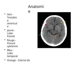 Anatomi
e
• Vert -
Troisièm
e
ventricul
e
• Jaune -
Lobe
frontal
• Rouge -
Fissure
sylvienne
• Bleu -
Lobe
temporal
• Orange - Citerne de
 
