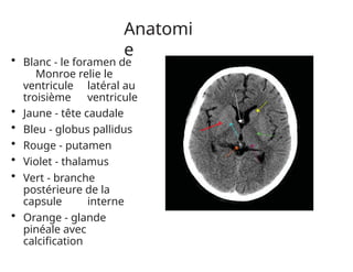 Anatomi
e
• Blanc - le foramen de
Monroe relie le
ventricule latéral au
troisième ventricule
• Jaune - tête caudale
• Bleu - globus pallidus
• Rouge - putamen
• Violet - thalamus
• Vert - branche
postérieure de la
capsule interne
• Orange - glande
pinéale avec
calcification
 
