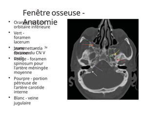 Fenêtre osseuse -
Anatomie
• Orange - fissure
orbitaire inférieure
• Vert -
foramen
lacerum
• Jaune -
foramen
ovale
3e
transmettantla
division du CN V
• Rouge - foramen
spinosum pour
l'artère méningée
moyenne
• Pourpre - portion
pétreuse de
l'artère carotide
interne
• Blanc - veine
jugulaire
 
