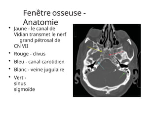 Fenêtre osseuse -
Anatomie
• Jaune - le canal de
Vidian transmet le nerf
grand pétrosal de
CN VII
• Rouge - clivus
• Bleu - canal carotidien
• Blanc - veine jugulaire
• Vert -
sinus
sigmoïde
 