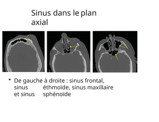 Sinus dans le plan
axial
• De gauche à droite : sinus frontal,
sinus éthmoïde, sinus maxillaire
et sinus sphénoïde
 
